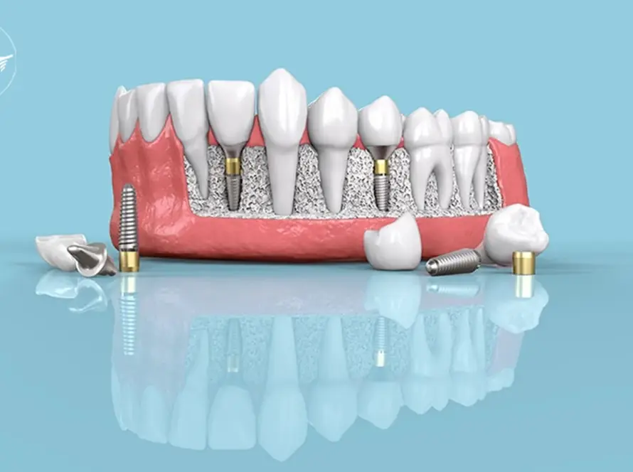implant fiyatları